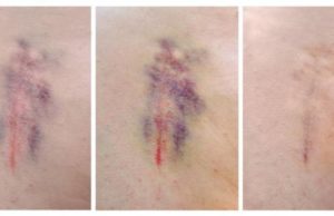 ¿Por qué se producen los hematomas?