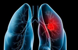 Un hallazgo de investigadores americanos abre la puerta a un tratamiento para un tipo de cáncer de pulmón agresivo