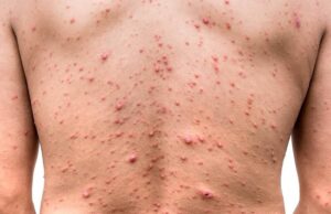 Casos emergentes de viruela del mono: expertos recomiendan el uso del cubrebocas