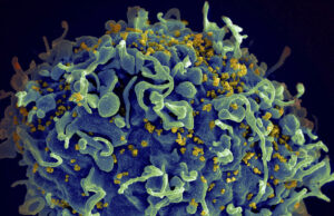 Mediante un peligroso tratamiento de trasplante de células madre, un paciente de 66 años es curado de VIH y leucemia