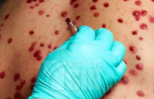 No hay casos activos de viruela del mono dice Salud Pública